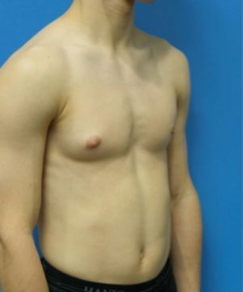 Gynecomastia Reduction Before & After Gallery - Patient 392759 - Image 3