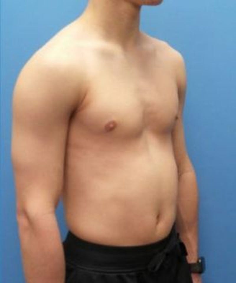 Gynecomastia Reduction Before & After Gallery - Patient 392759 - Image 4