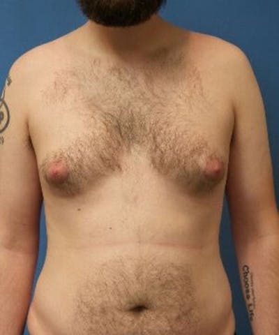 Gynecomastia Reduction Before & After Gallery - Patient 211751 - Image 1