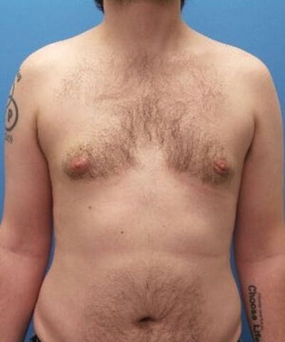 Gynecomastia Reduction Before & After Gallery - Patient 211751 - Image 2