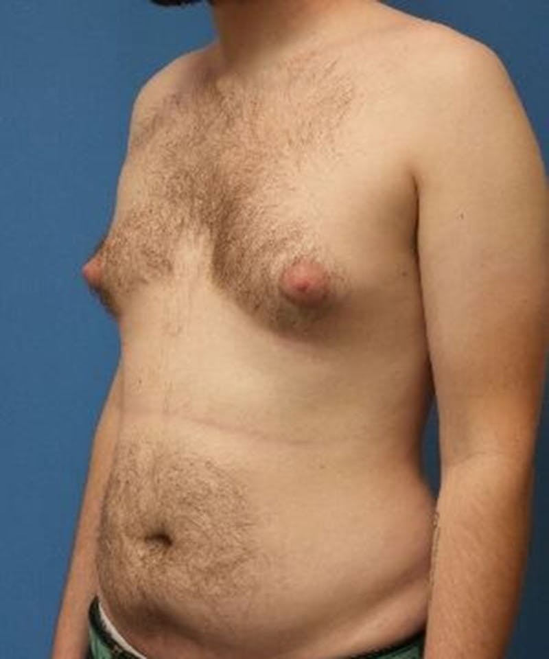 Gynecomastia Reduction Before & After Gallery - Patient 211751 - Image 3