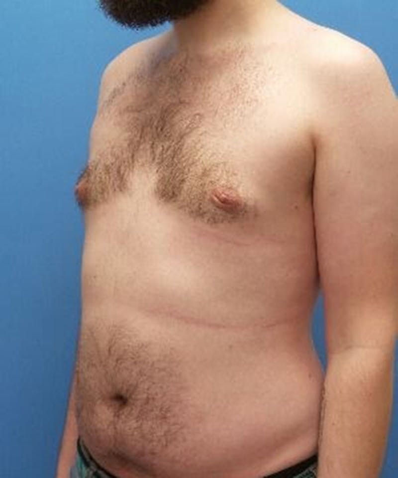 Gynecomastia Reduction Before & After Gallery - Patient 211751 - Image 4