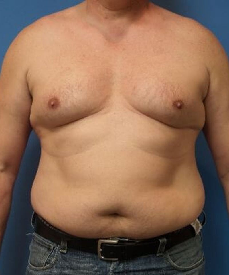 Gynecomastia Reduction Before & After Gallery - Patient 132524 - Image 1