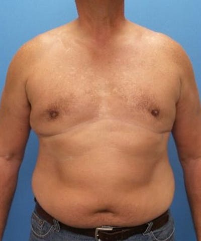 Gynecomastia Reduction Before & After Gallery - Patient 132524 - Image 2