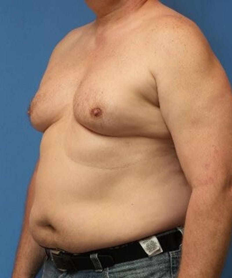 Gynecomastia Reduction Before & After Gallery - Patient 132524 - Image 3