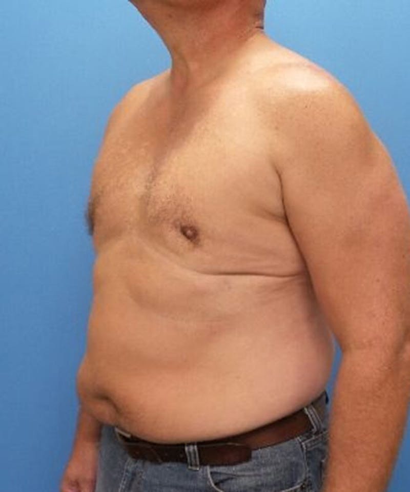 Gynecomastia Reduction Before & After Gallery - Patient 132524 - Image 4