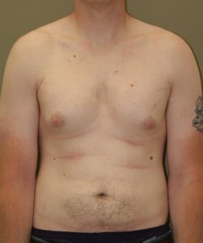Gynecomastia Reduction Before & After Gallery - Patient 402020 - Image 1