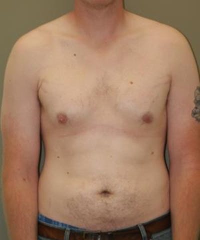 Gynecomastia Reduction Before & After Gallery - Patient 402020 - Image 2