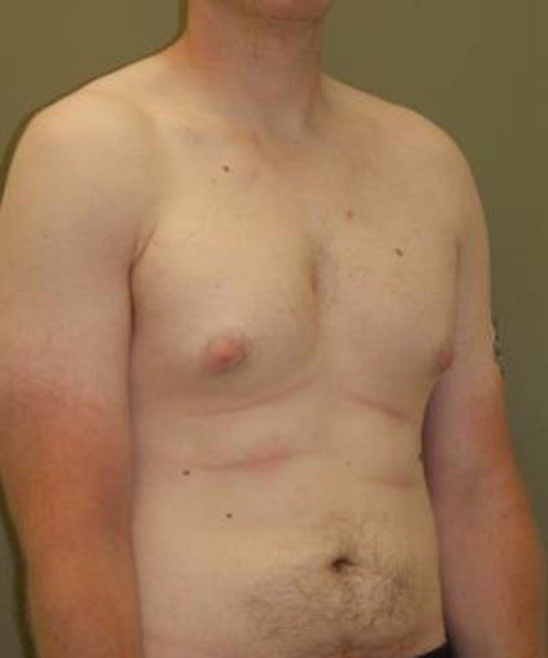 Gynecomastia Reduction Before & After Gallery - Patient 402020 - Image 3
