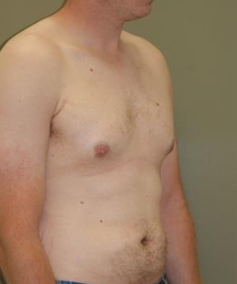 Gynecomastia Reduction Before & After Gallery - Patient 402020 - Image 4