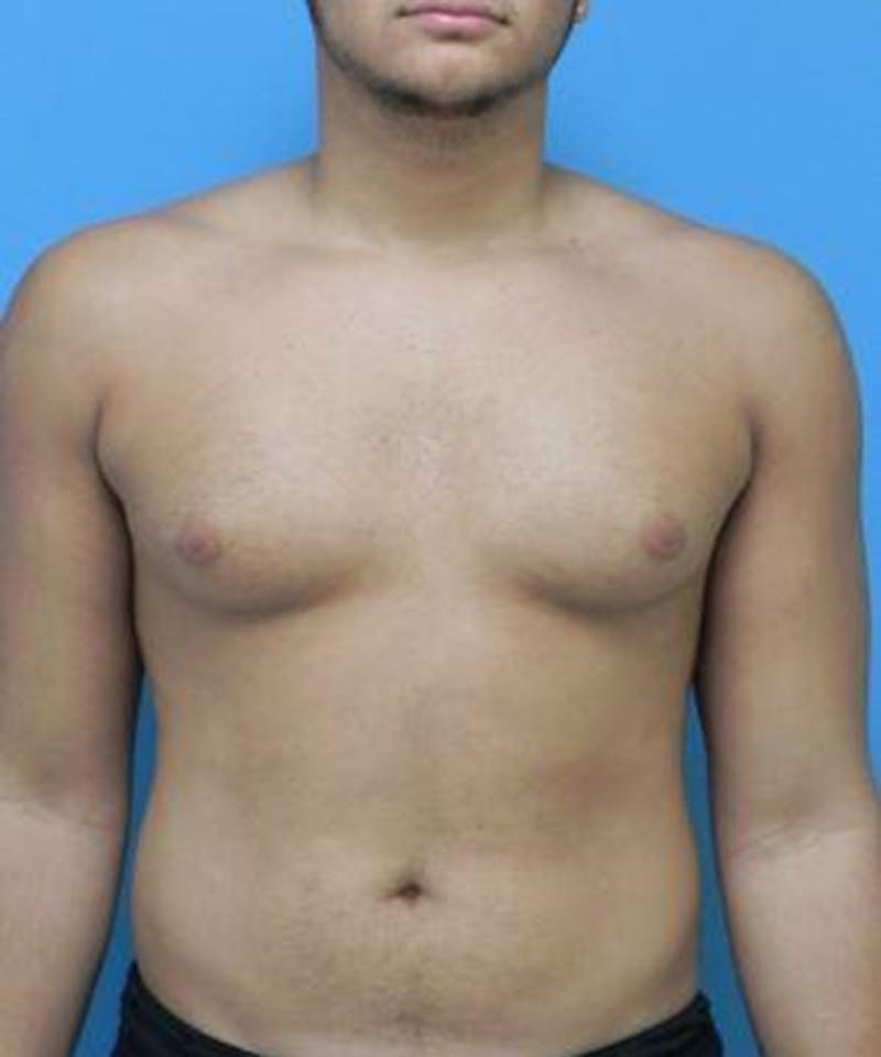 Gynecomastia Reduction Before & After Gallery - Patient 116153 - Image 1