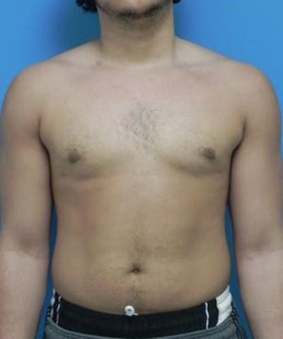 Gynecomastia Reduction Before & After Gallery - Patient 116153 - Image 2