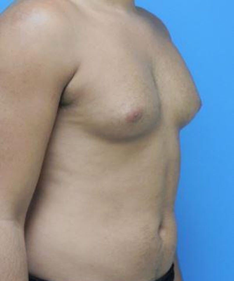 Gynecomastia Reduction Before & After Gallery - Patient 116153 - Image 3