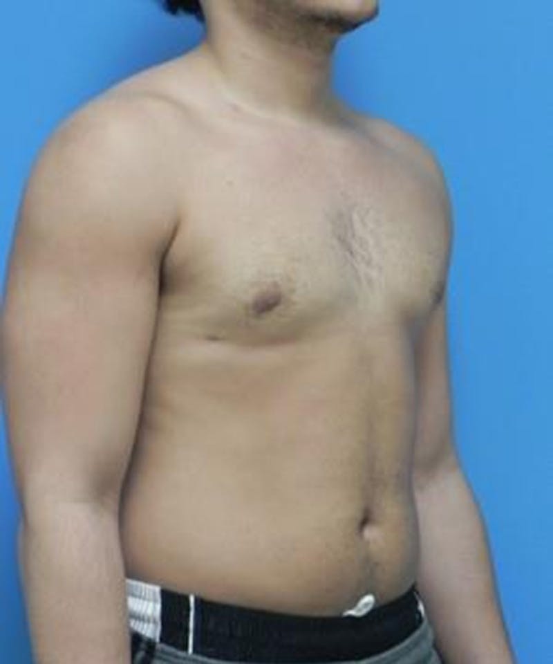 Gynecomastia Reduction Before & After Gallery - Patient 116153 - Image 4