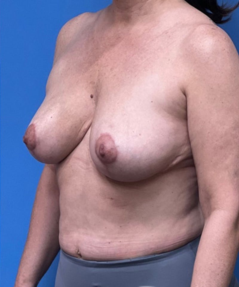 Breast Reduction Before & After Gallery - Patient 702650 - Image 4