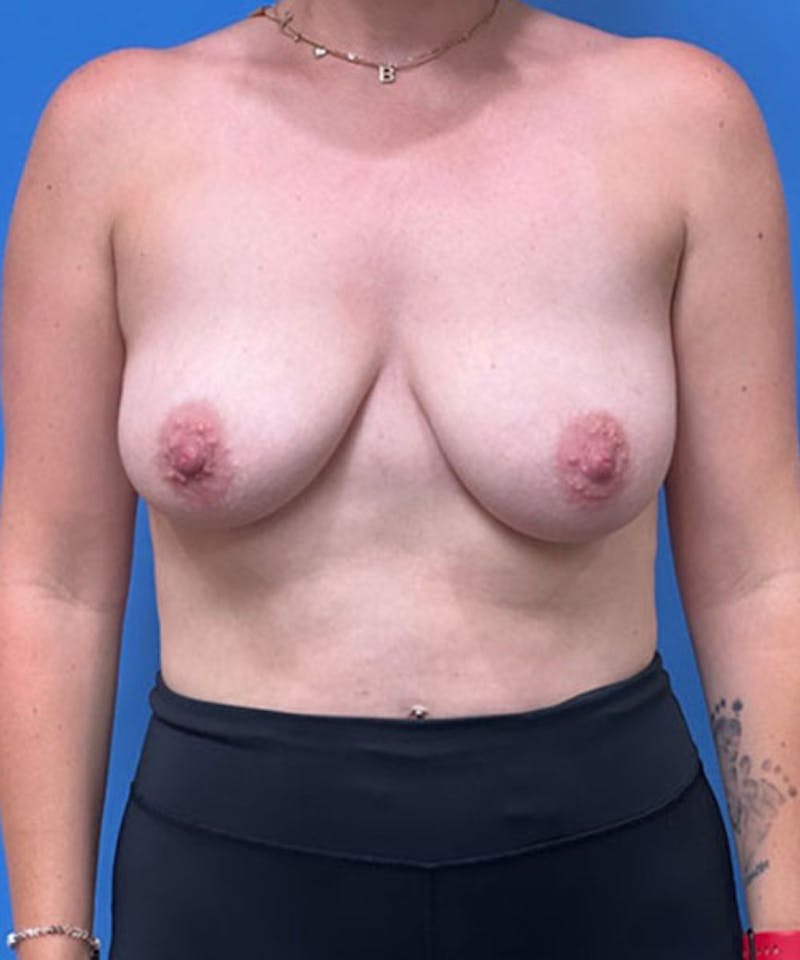 Breast Reduction Before & After Gallery - Patient 286810 - Image 1