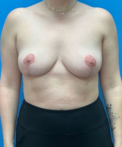 Breast Reduction Before & After Gallery - Patient 286810 - Image 2