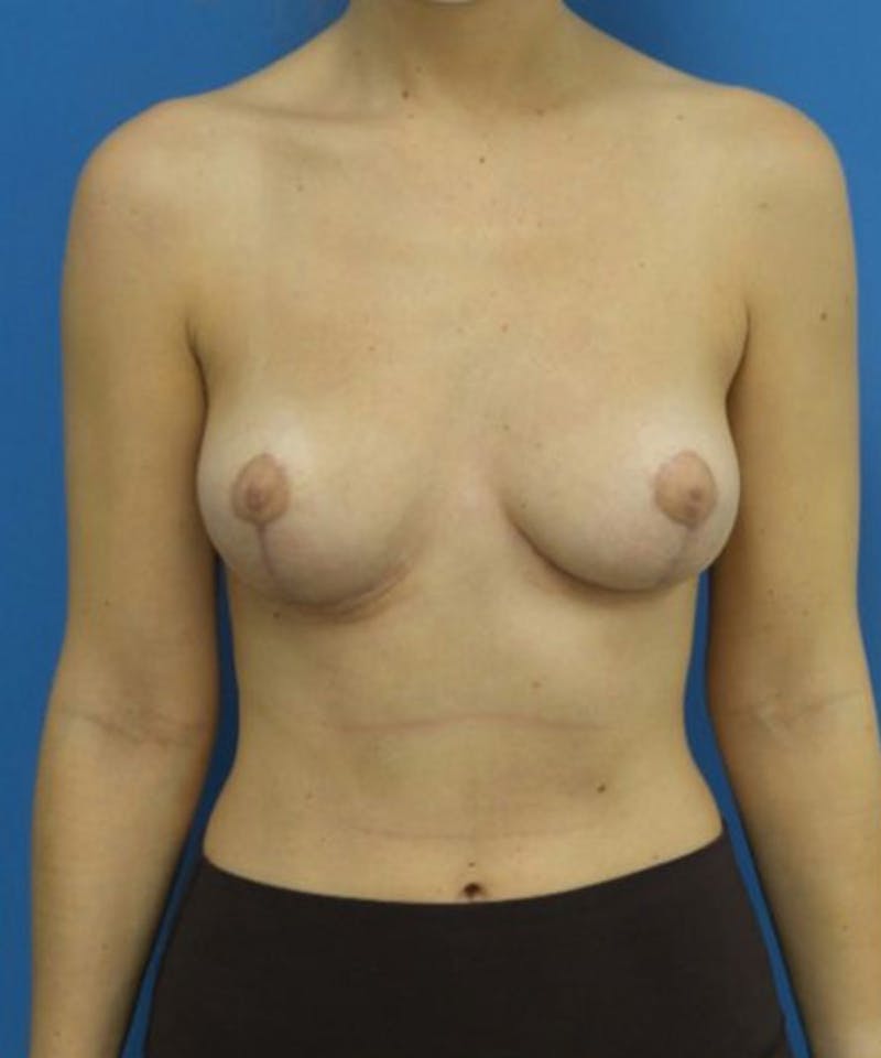 Breast Reduction Before & After Gallery - Patient 307499 - Image 2