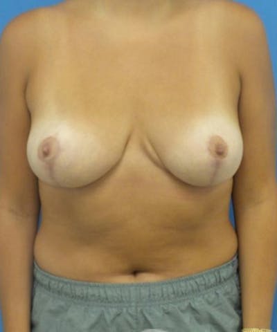 Breast Reduction Before & After Gallery - Patient 292492 - Image 2