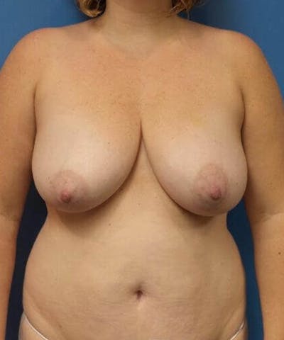 Breast Reduction Before & After Gallery - Patient 312310 - Image 1