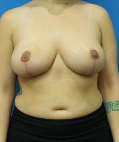 Breast Reduction Before & After Gallery - Patient 340776 - Image 2