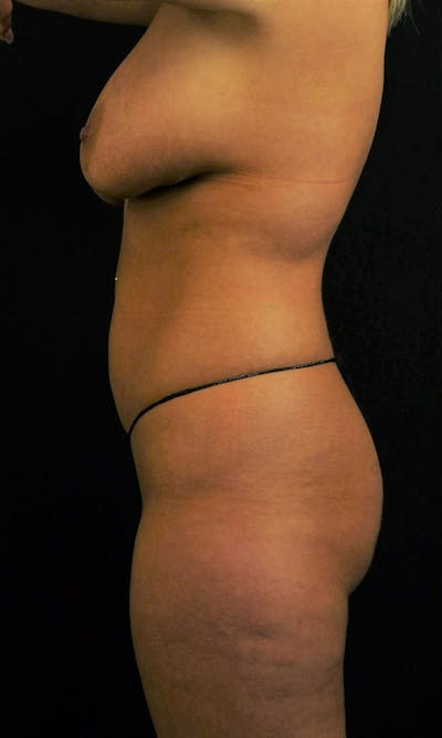 Liposuction Before & After Gallery - Patient 274392 - Image 1