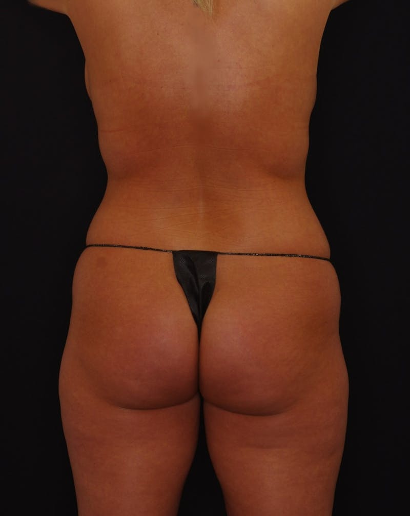 Liposuction Before & After Gallery - Patient 274392 - Image 5