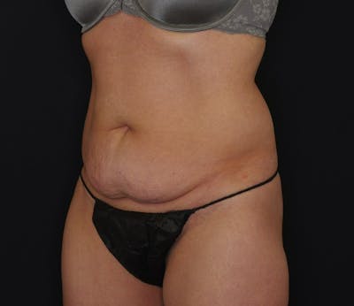 Abdominoplasty Before & After Gallery - Patient 289817 - Image 1