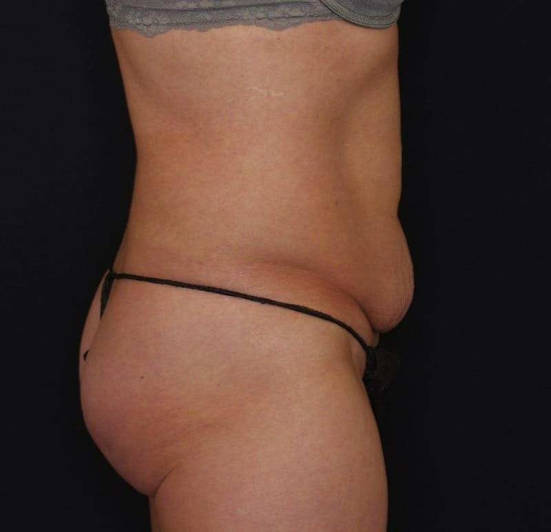 Abdominoplasty Before & After Gallery - Patient 289817 - Image 3