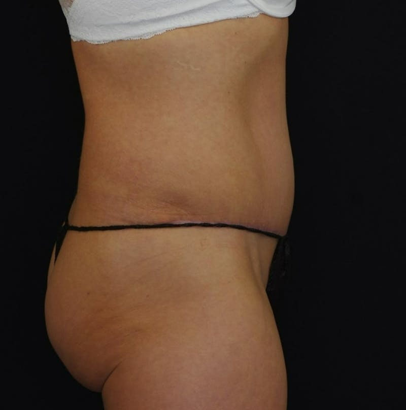 Abdominoplasty Before & After Gallery - Patient 289817 - Image 4