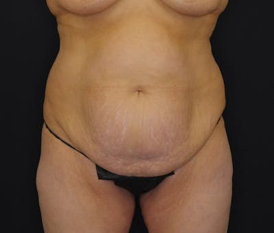 Abdominoplasty Before & After Gallery - Patient 243226 - Image 1