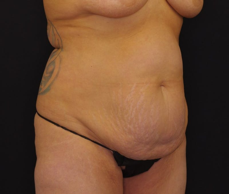 Abdominoplasty Before & After Gallery - Patient 243226 - Image 3