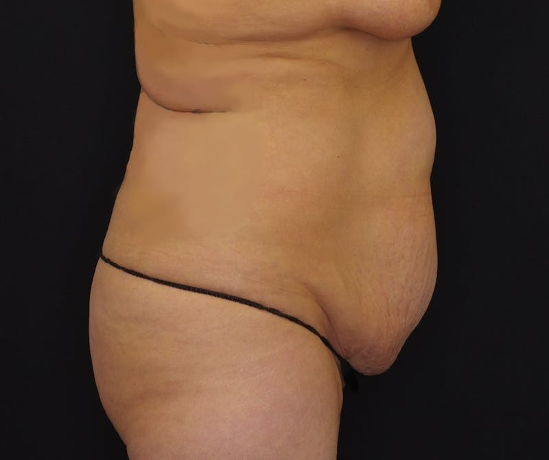 Abdominoplasty Before & After Gallery - Patient 243226 - Image 5