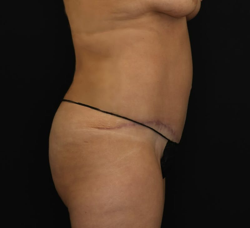 Abdominoplasty Before & After Gallery - Patient 243226 - Image 6
