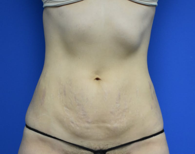 Abdominoplasty Before & After Gallery - Patient 936239 - Image 5
