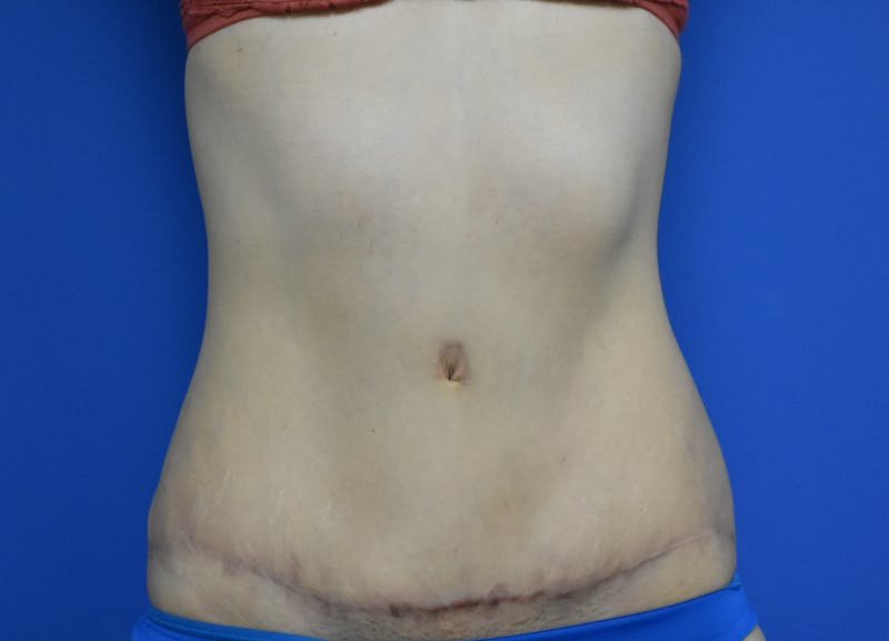Abdominoplasty Before & After Gallery - Patient 936239 - Image 6