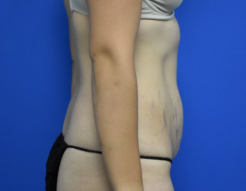 Abdominoplasty Before & After Gallery - Patient 936239 - Image 3