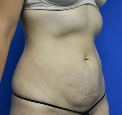 Abdominoplasty Before & After Gallery - Patient 936239 - Image 1