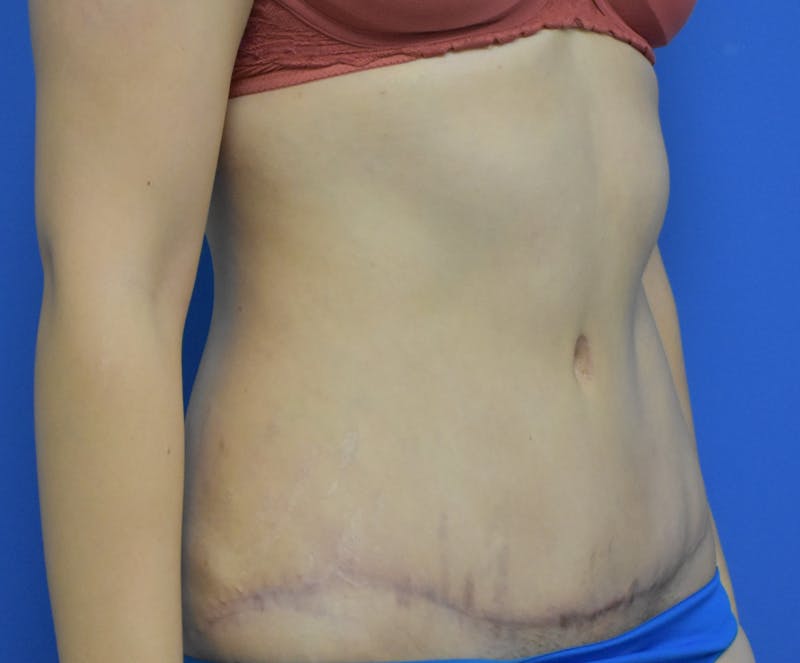 Abdominoplasty Before & After Gallery - Patient 936239 - Image 2