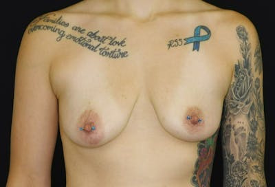 Breast Lift Before & After Gallery - Patient 238838 - Image 1