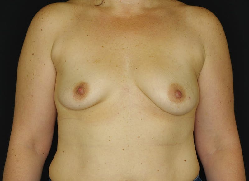 Breast Augmentation Before & After Gallery - Patient 669075 - Image 1