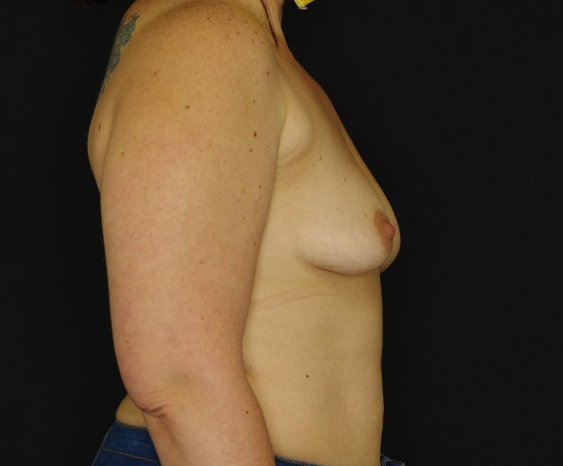 Breast Lift Before & After Gallery - Patient 233858 - Image 3