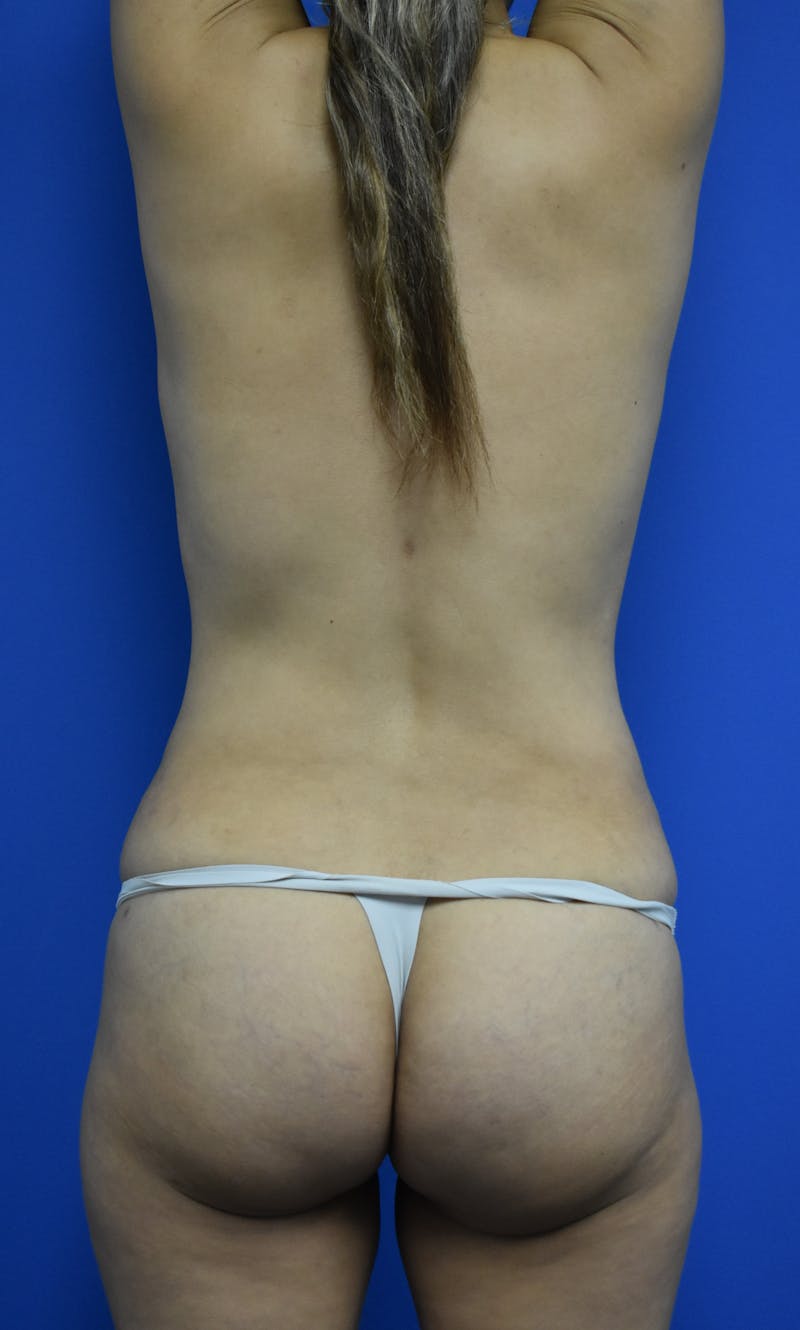 Liposuction Before & After Gallery - Patient 103294 - Image 4