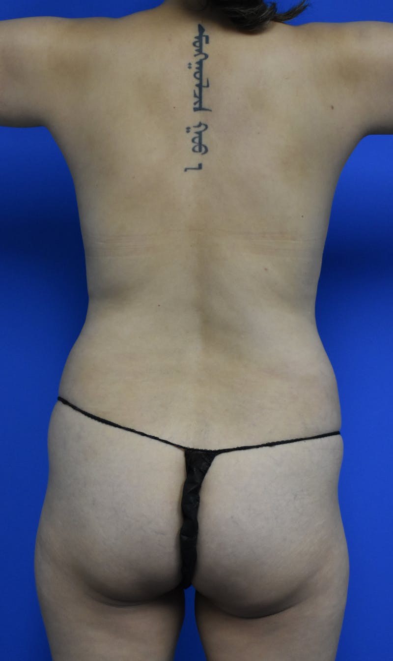 Liposuction Before & After Gallery - Patient 103294 - Image 3