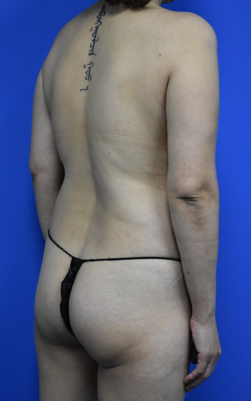 Liposuction Before & After Gallery - Patient 103294 - Image 1