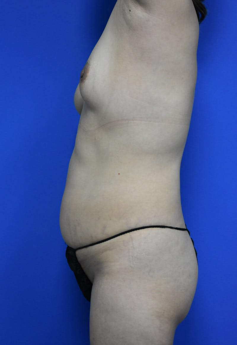 Liposuction Before & After Gallery - Patient 103294 - Image 5