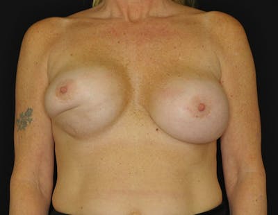 Breast Lift Before & After Gallery - Patient 162690 - Image 1