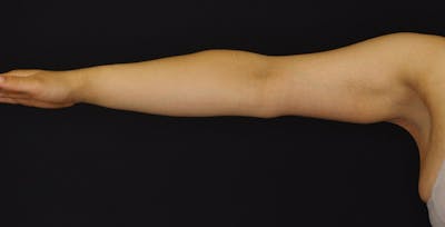 Brachioplasty Before & After Gallery - Patient 371846 - Image 2