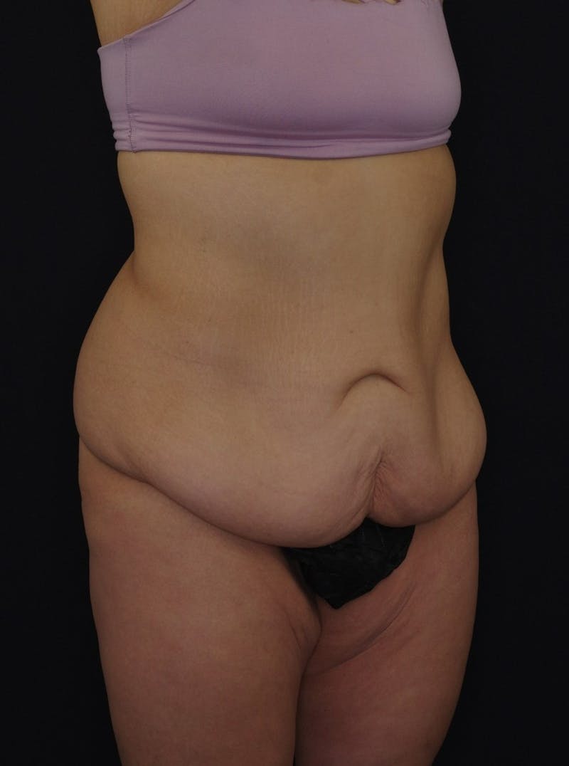 Liposuction Before & After Gallery - Patient 251562 - Image 1