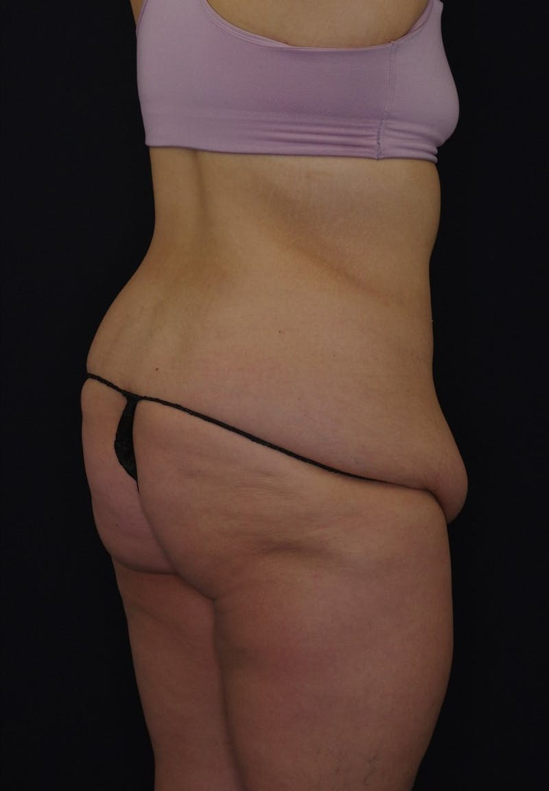 Liposuction Before & After Gallery - Patient 251562 - Image 3